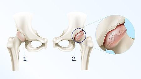 Detail artrózy - poškodený bedrový kĺb