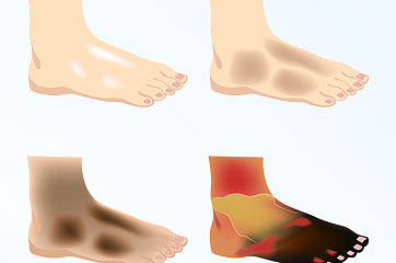 Štádiá ischémie nohy – postupný rozvoj gangrény