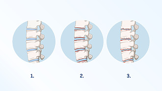 Postihnutie chrbtice pri ankylozujúcej spondylitíde. Na obrázku 1 je zdravá chrbtica. Obrázok 2 a 3 ukazuje postihnutie pri ankylozujúcej spondylitíde.