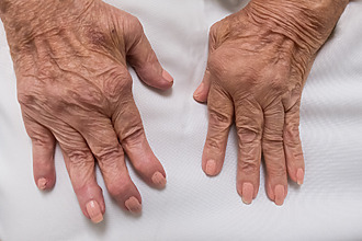 Artritída kĺbov na rukách – postihnuté kĺby treba šetriť