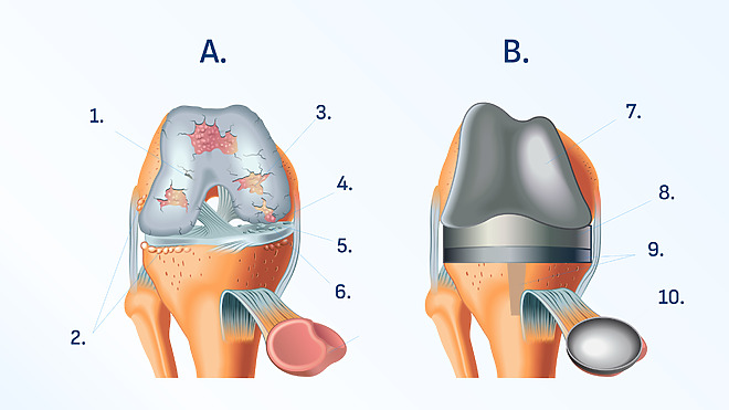 Kolenný kĺb pred a po operácii.