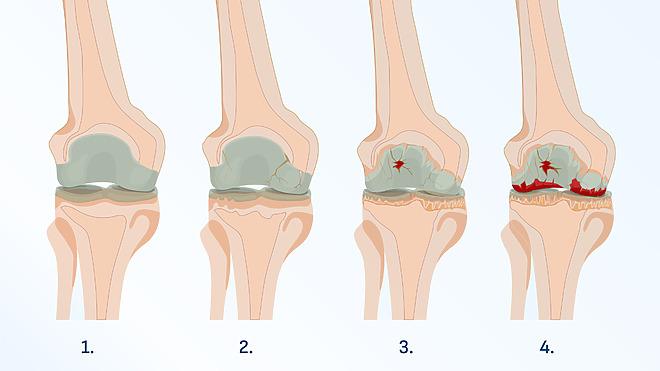 Štádia artrózy kolena