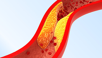Ateroskleróza – tukové častice sa hromadia v cievach