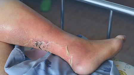 Obrázok: Bércové vredy