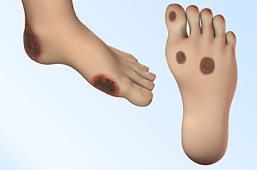 Pri cukrovke sú často na prstoch na nohách a na chodidlách.