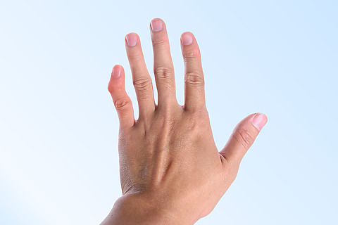 Deformácia prstu - jeden z príznakov zlomeniny