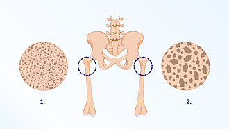 Denzitometria ukáže hustotu kostného tkaniva