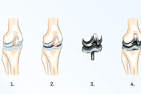 Endoprotéza kolena poškodeného artrózou. 1 - Zdravý bedrový kĺb. 2 - Artróza. 3 - Kĺbová náhrada. 4 - Endoprotéza bedrového kĺbu.