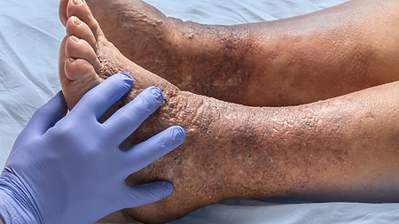 Ischaemic limb disease