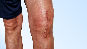 Podoba jazvy po endoprotéze kolena