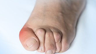 Kladivkové prsty zvyšujú riziko syndrómu diabetickej nohy