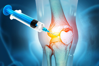 Artróza kolena – injekcia
