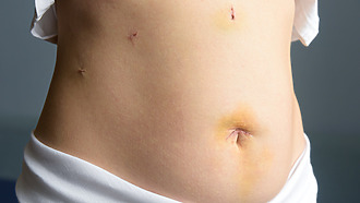 Result of laparoscopic surgery: several small wounds instead of a long incision