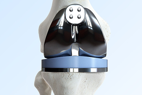 Náhrada kolenného kĺbu umelým implantátom