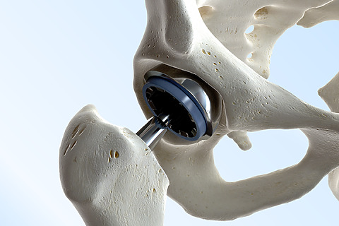 Náhrada bedrového kĺbu umelým implantátom