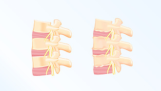Opotrebovanie chrbtice – hlavná príčina artrózy chrbtice