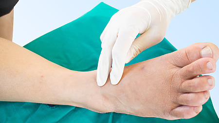 Obrázok: Polyneuropatia