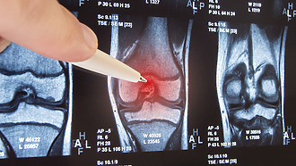 Poškodenie kĺbovej chrupavky je vidieť na röntgene aj magnetickej rezonancii