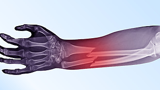 Definícia zlomeniny: narušenie celistvosti kosti