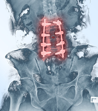 Röntgenová snímka bedrovej chrbtice po operácii – spevnenie postihnutého miesta železnými skrutkami