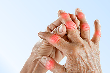 Kĺby na prstoch ruky môžu byť zväčšené a zdeformované