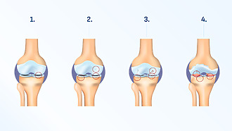 Artróza kolenného kĺbu – štádia choroby