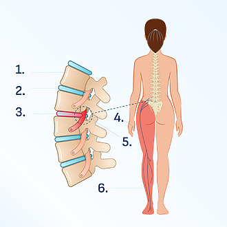 Vyskočená medzistavcová platnička v bedrovej chrbtici - jedna z príčin ischiasu, bolesti bývajú jednostranné.