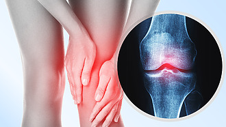 Bolesť a opuch kolena – typické príznaky artrózy