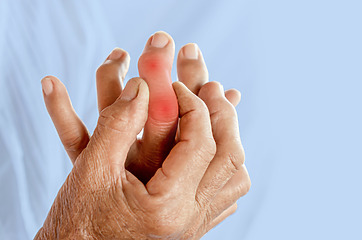 Kĺby na prstoch ruky môžu byť zväčšené a zdeformované